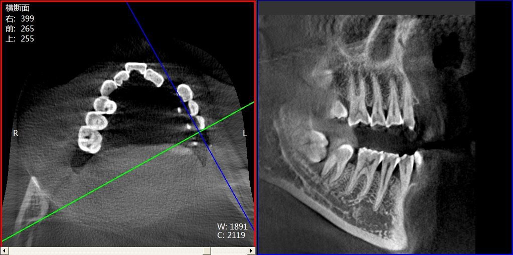 Dental X Ray
